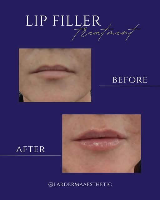 Before and after example of natural lip enhancement by La Derma