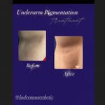 Before and after example of pigmentation-focused treatment by La Derma